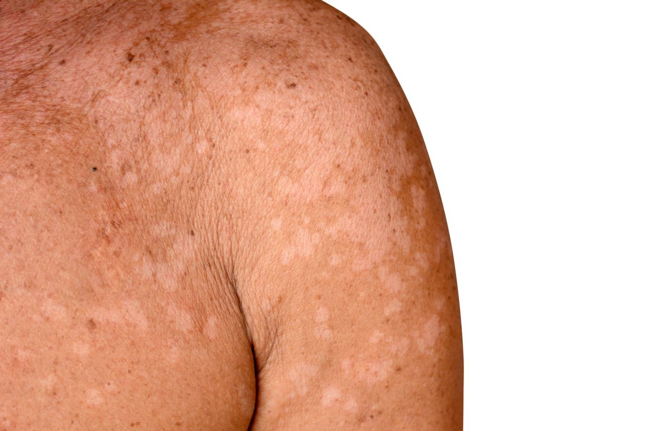 Fungal Infections of the Skin