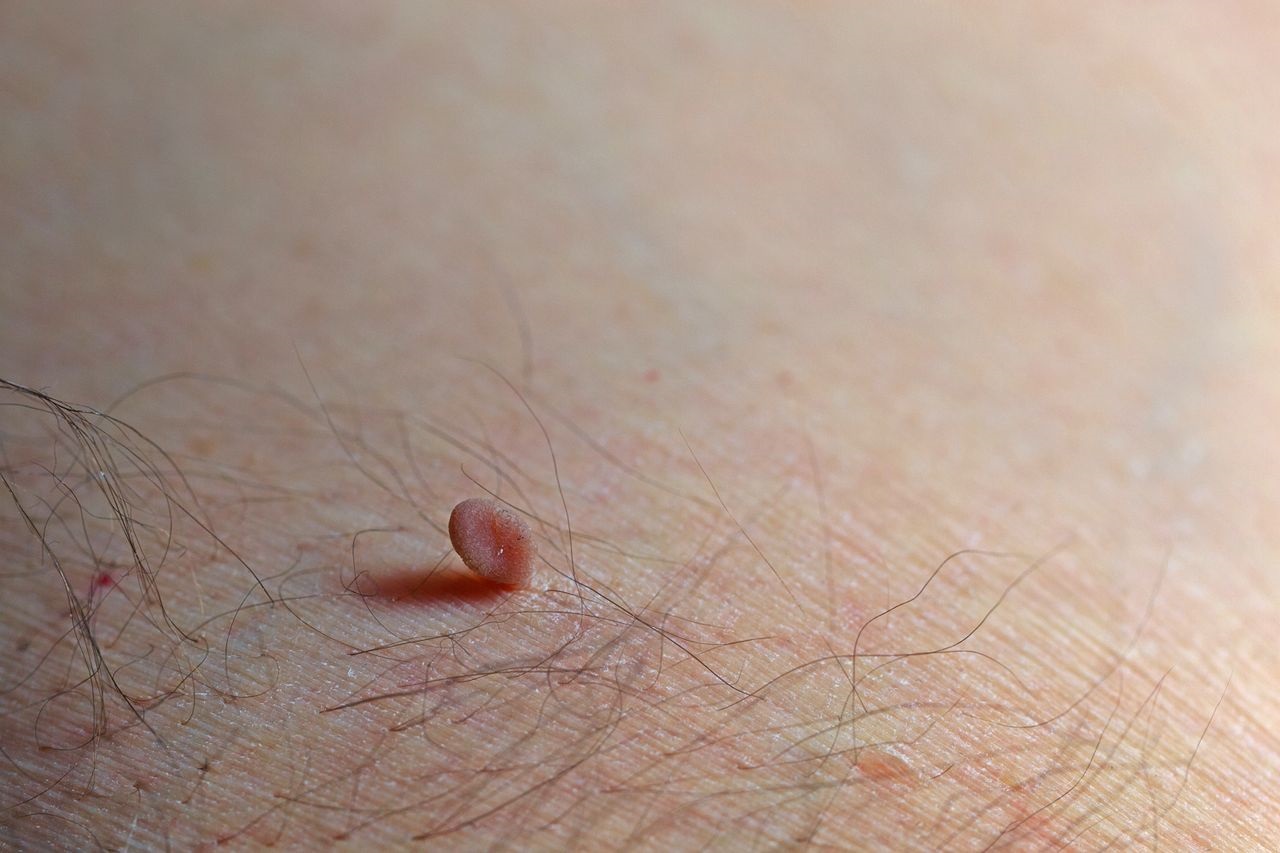 Skin Tags - English Dermatology
